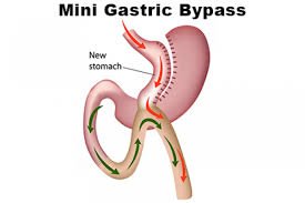 Laparoscopic Mini Gastric Bypass Diagram